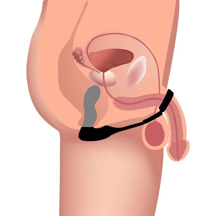 Swell 10X Inflatable and Vibrating Prostate Plug with Cock and Ball Ring Male Sex Toys